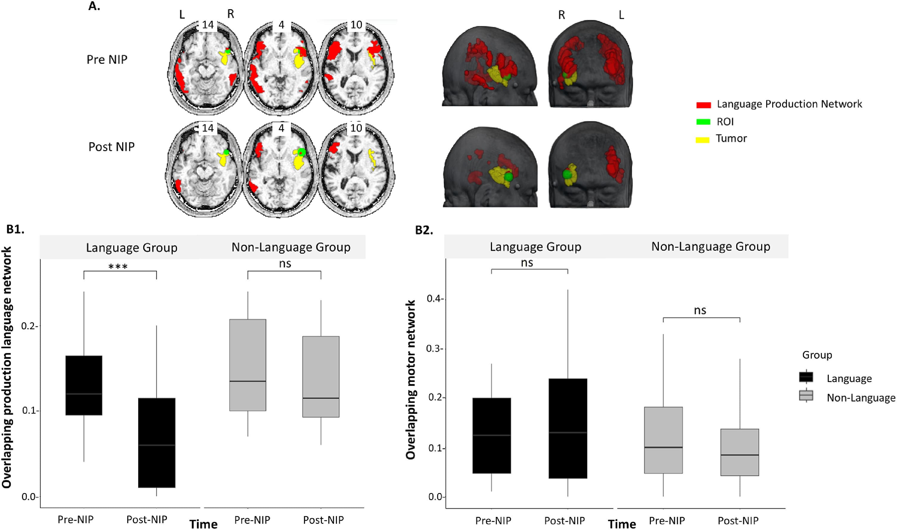 Un estudi de Guttmann coliderat per un professor de la UdL avala entrenar el llenguatge abans d'extreure un tumor cerebral